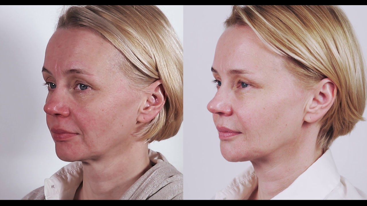 Non-Invasive Face Lift For Beautification